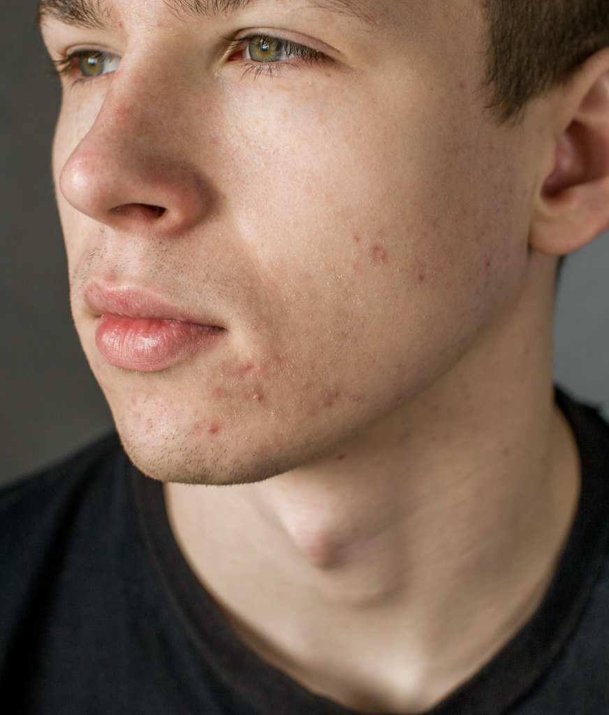 Man with acne and acne scarring