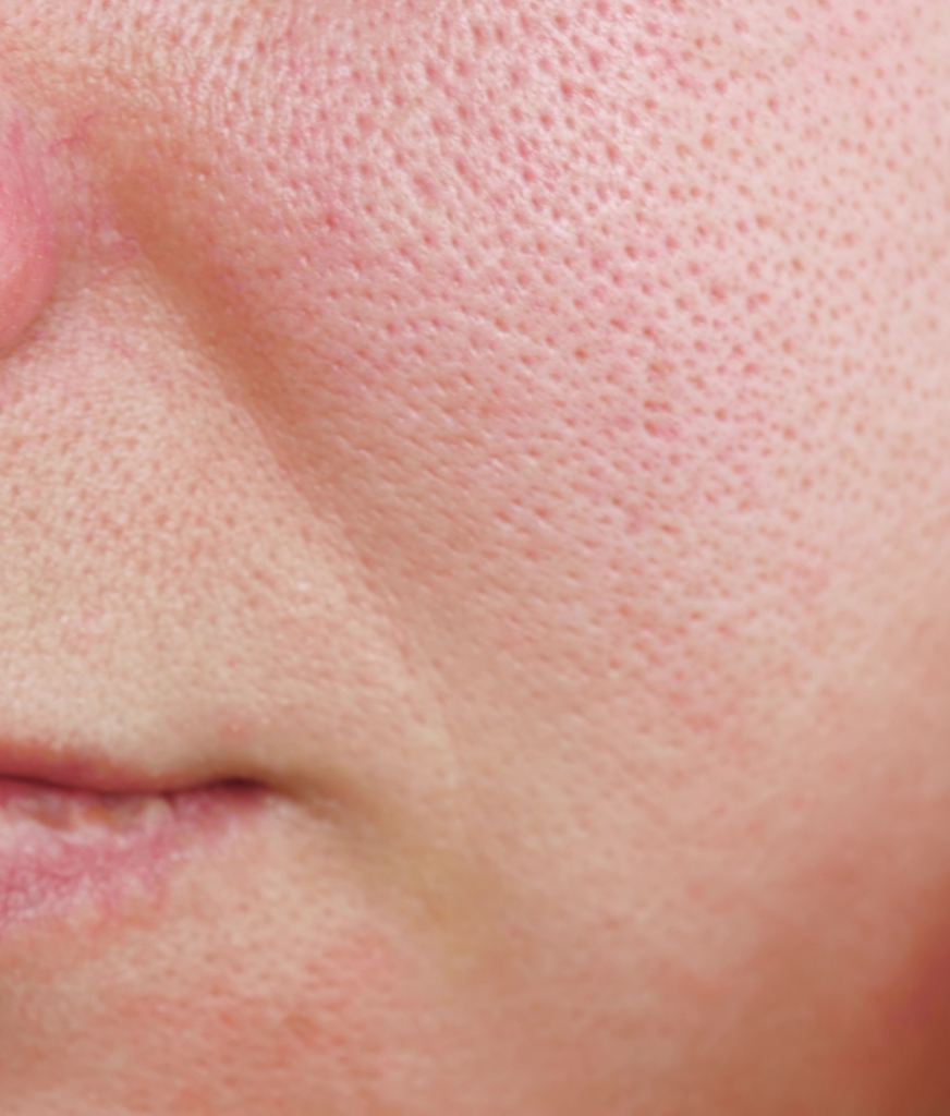 Closeup on enlarged pores