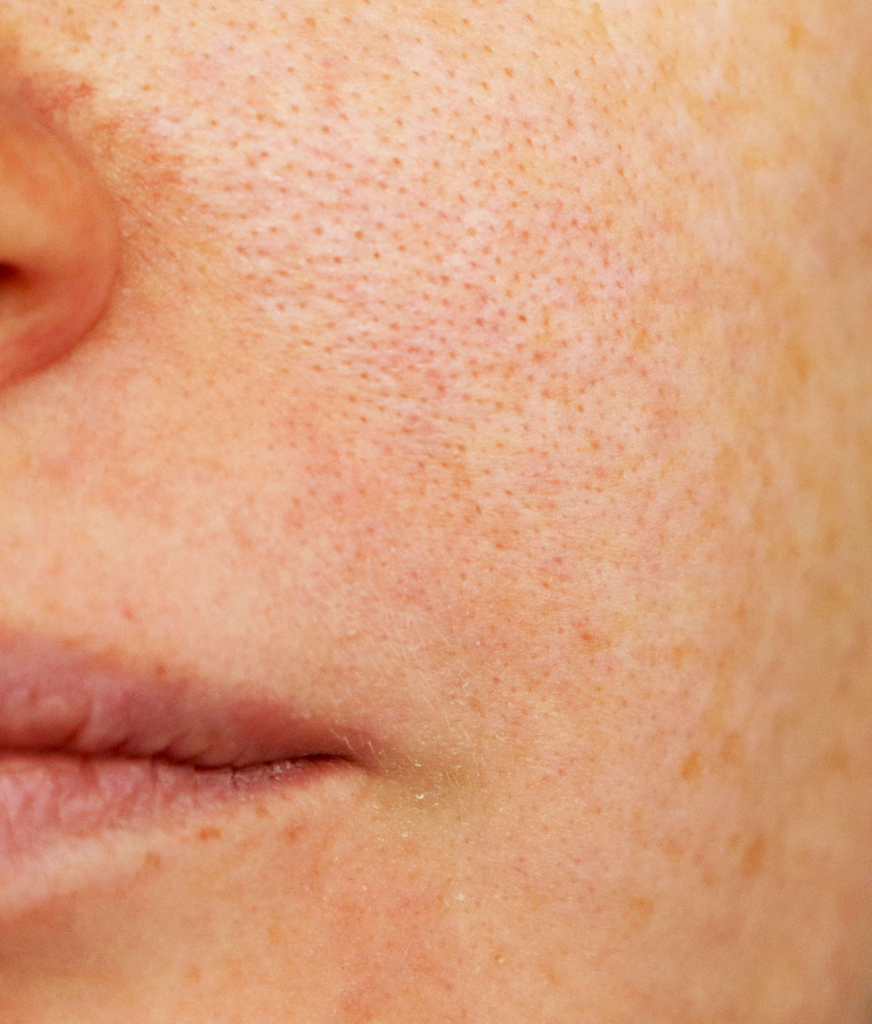 Close up on skin with hyperpigmentation