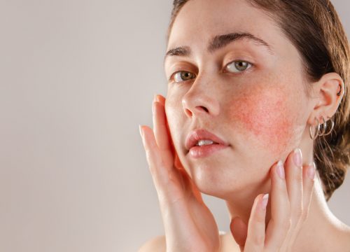 Woman with rosacea on her face