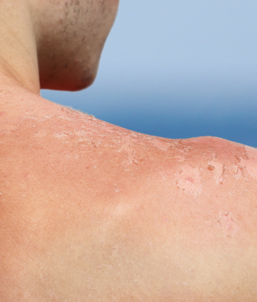 sun damage on a man's back