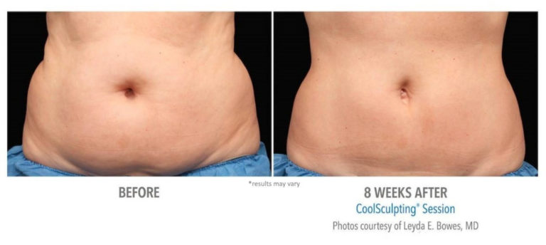 necbs-coolsculpting-before-after-4