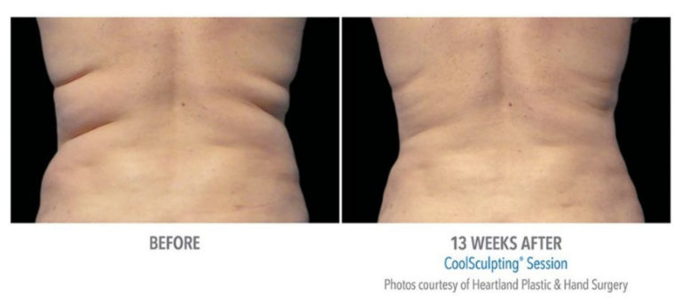 coolsculpting_before_and_after_Docere_Strongsville_4