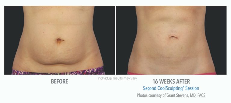 coolsculpting_3-before-and-after