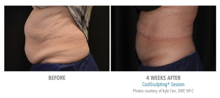 coolsculpting_4-before-and-after