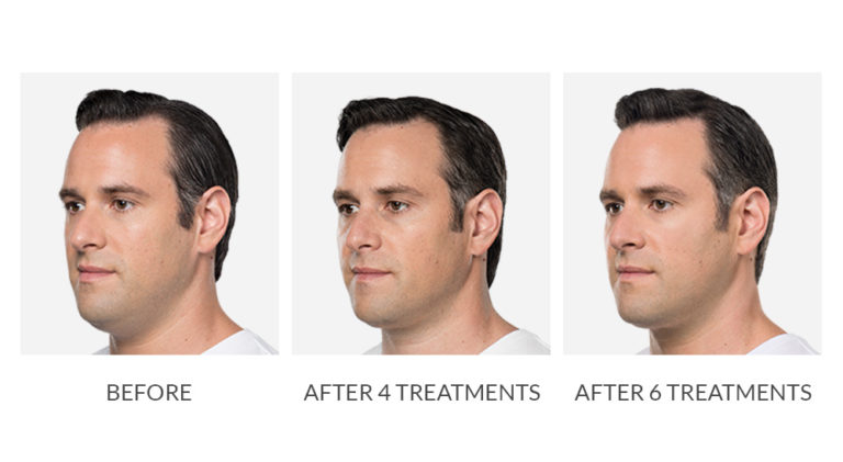 kybella Before and after image by Fresh Aesthetics Medical Spa in Twin Falls, ID