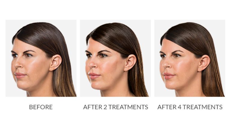 kybella Before and after image by Fresh Aesthetics Medical Spa in Twin Falls, ID
