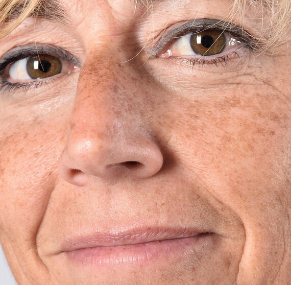 Photo of a woman with age spots on her face