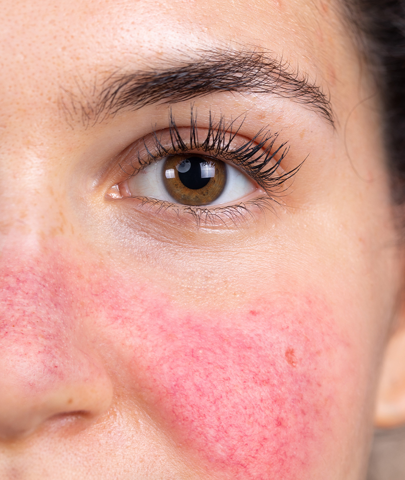 Photo of a brown-eyed woman with rosacea
