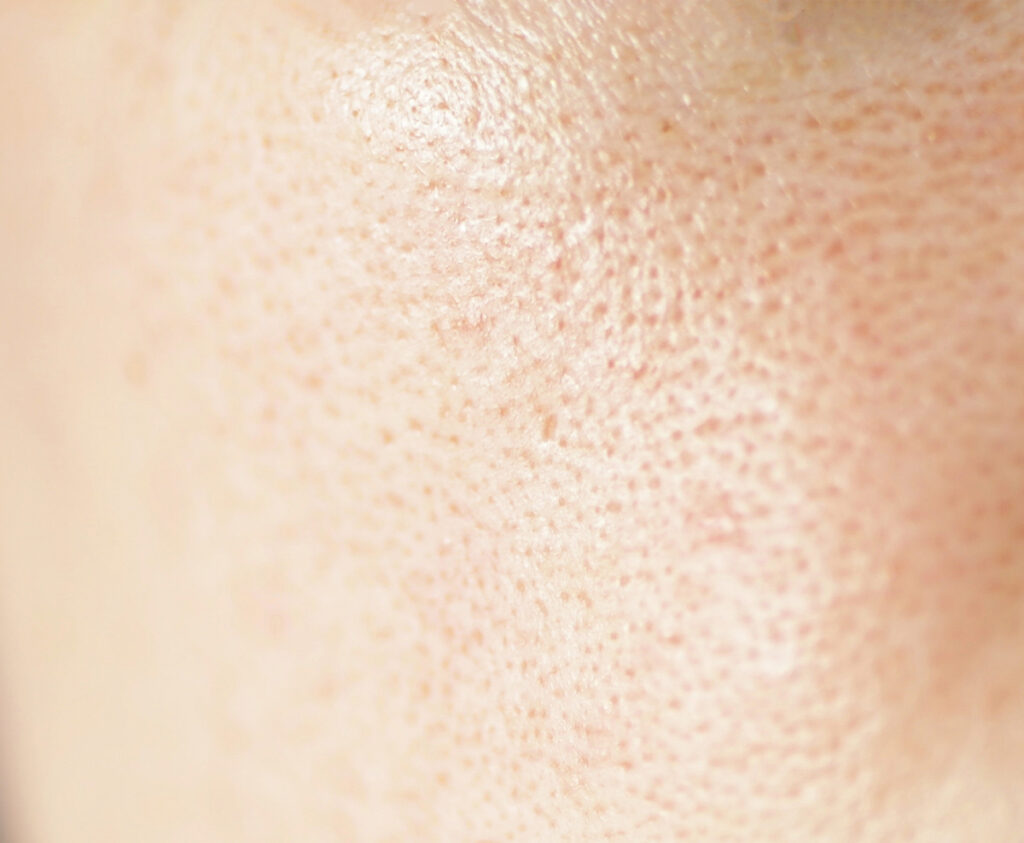 Photo of enlarged pores