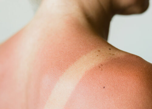 Photo of sun damage on a woman's back and shoulders
