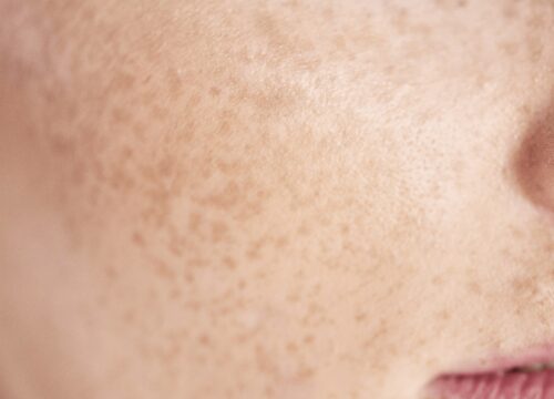 Photo of hyperpigmentation on a woman's face