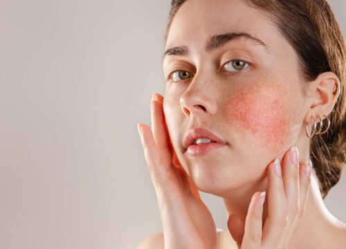 Photo of a woman with rosacea