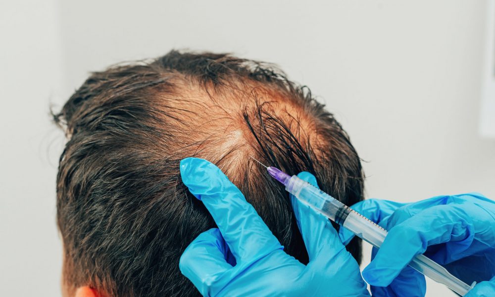 PRP-For-Hair-Restoration